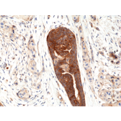 Immunohistochemical staining of formalin fixed and paraffin embedded human breast cancer tissue section using anti-VEGF rabbit monoclonal antibody (Clone RM391) at a 1:100 dilution.