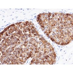 Immunohistochemical staining of formalin fixed and paraffin embedded human breast ductal carcinoma tissue, stained with anti-B7H4 rabbit monoclonal antibody clone RM525 at 1:100 dilution.