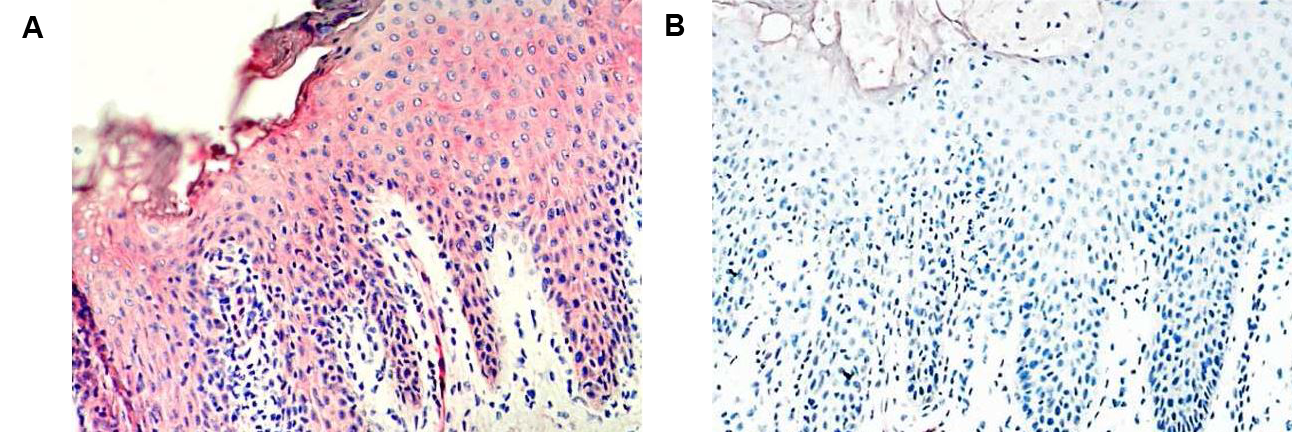 Immunohistochemical staining of vaspin with anti-Vaspin (human), mAb (VP63) (AG-20A-0045) in psoriatic skin lesions (A). Negative control for vaspin in psoriatic skin lesions (B). Blue hematoxylin stained cell nuclei.