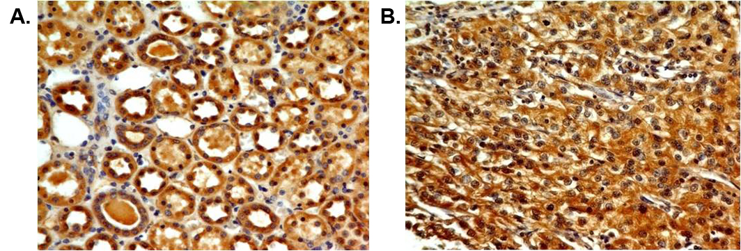 Immunohistochemical analysis of TLR7 in paraffin-embeded sections of A) human kidney tissue and B) renal cell carinoma, using anti-TLR7 (human), mAb (ABM2C27) (AG-20T-0306) at 5?g/ml.