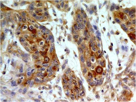 Immunohistochemical analysis of TLR8 in paraffin-embeded sections of small cell carcinoma of esophagus using anti-TLR8 (human), mAb (ABM15F6) (AG-20T-0307) at 5?g/ml.