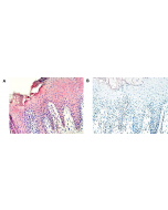 Immunohistochemical staining of vaspin with anti-Vaspin (human), mAb (VP63) (AG-20A-0045) in psoriatic skin lesions (A). Negative control for vaspin in psoriatic skin lesions (B). Blue hematoxylin stained cell nuclei.
