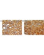 Immunohistochemical analysis of TLR7 in paraffin-embeded sections of A) human kidney tissue and B) renal cell carinoma, using anti-TLR7 (human), mAb (ABM2C27) (AG-20T-0306) at 5µg/ml.