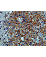 Immunohistochemical staining of formalin fixed and paraffin embedded melanoma tissue sections.