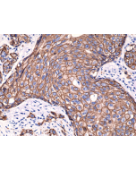 Immunohistochemical staining of FFPE humanbreast cancer tissue sections, using Anti-HER2 (c-erbB-2) Rabbit Monoclonal antibody RM228.
