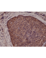 Immunohistochemical staining of formalin fixed and paraffin embedded human breast cancer tissue sections using Anti-p38 MAPK RM245 at a 1:5000 dilution.