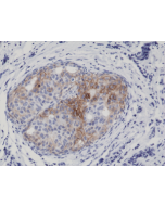 Immunohistochemical staining of formalin fixed and paraffin embedded human breast cancer tissue sections using Anti-Phospho-EGFR (Tyr1173) Rabbit Monoclonal Antibody (clone RM269) at a 1:5000 dilution.