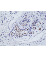 Immunohistochemical staining of formalin fixed and paraffin embedded human breast cancer tissue sections using Anti-ER-alpha Rabbit Monoclonal Antibody (Clone RM292) at a 1:100 dilution.