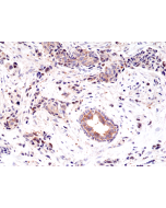Immunohistochemical staining of formalin fixed and paraffin embedded human breast cancer tissue sections using anti-EGF Receptor rabbit monoclonal antibody (clone RM294) at a 1:200 dilution.