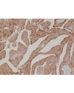 Immunohistochemical staining of formalin fixed and paraffin embedded human prostate cancer tissue section using anti-PSA rabbit monoclonal antibody (Clone RM323) at a 1:1000 dilution.