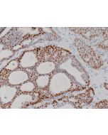 Immunohistochemical staining of formalin fixed and paraffin embedded human breast cancer tissue sections using Anti-Progesterone Receptor (PR) Rabbit Monoclonal Antibody (Clone RM357) at a 1:100 dilution.