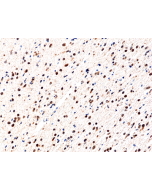 Immunohistochemical staining of formalin fixed and paraffin embedded human glioblastoma using Anti-IDH1(R132H) Rabbit Monoclonal Antibody (Clone RM390) at a 1:100 dilution.