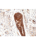 Immunohistochemical staining of formalin fixed and paraffin embedded human breast cancer tissue section using anti-VEGF rabbit monoclonal antibody (Clone RM391) at a 1:100 dilution.