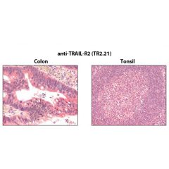 Immunohistochemistry detection of endogenous TRAIL-R2 in paraffin-embedded human carcinoma tissues (colon, tonsil) using mAb to TRAIL-R2 (TR2.21) (Prod. No. AG-20B-0028).