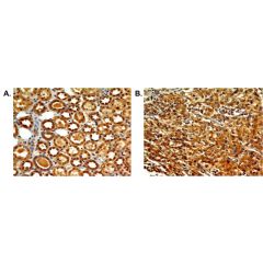Immunohistochemical analysis of TLR7 in paraffin-embeded sections of A) human kidney tissue and B) renal cell carinoma, using anti-TLR7 (human), mAb (ABM2C27) (AG-20T-0306) at 5µg/ml.