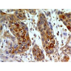 Immunohistochemical analysis of TLR8 in paraffin-embeded sections of small cell carcinoma of esophagus using anti-TLR8 (human), mAb (ABM15F6) (AG-20T-0307) at 5µg/ml.