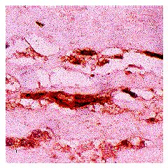 Immunohistochemical staining of MG adducts in atherosclerotic aorta using anti-MG, mAb (3C).