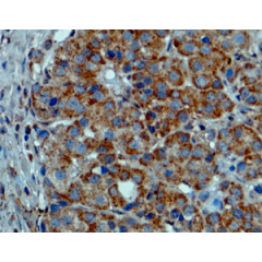 Immunohistochemical staining of formalin fixed and paraffin embedded melanoma tissue sections.
