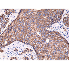 Immunohistochemical staining of FFPE humanbreast cancer tissue sections, using Anti-HER2 (c-erbB-2) Rabbit Monoclonal antibody RM228.