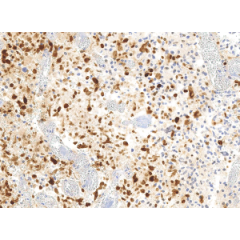 IHC of clinically validated FFPE Glioblastoma tumor tissues with H3.3 G34R expression, using anti-histone H3.3 G34R rabbit monoclonal antibody, Clone RM240. Clinically validated to be Positive for H3.3 G34R Mutation. Image courtesy of Dr. Sebastian Brandn