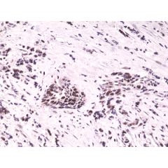 Immunohistochemical staining of formalin fixed and paraffin embedded human breast cancer tissue sections using Anti-HIF-1-alpha RM242 at a 1:1000 dilution.