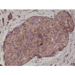 Immunohistochemical staining of formalin fixed and paraffin embedded human breast cancer tissue sections using Anti-E-cadherin RM244 at a 1:1000 dilution.