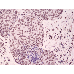 Immunohistochemical staining of formalin fixed and paraffin embedded human breast cancer tissue sections using Anti-Phospho-p38 MAPK (Thr180/Tyr182) RM243 at a 1:1000 dilution.