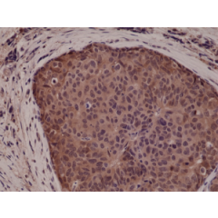Immunohistochemical staining of formalin fixed and paraffin embedded human breast cancer tissue sections using Anti-p38 MAPK RM245 at a 1:5000 dilution.