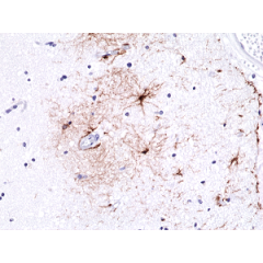 Immunohistochemical staining of formalin fixed and paraffin embedded human brain tissue sections using Anti-GFAP RM246 at a 1:500 dilution.