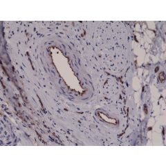 Immunohistochemical staining of formalin fixed and paraffin embedded human breast cancer tissue sections using Anti-CD31 RM247 at a 1:2500 dilution.