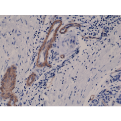 Immunohistochemical staining of formalin fixed and paraffin embedded human breast cancer tissue sections using Anti-CD146 RM249 at a 1:400 dilution.