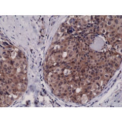 Immunohistochemical staining of formalin fixed and paraffin embedded human breast cancer tissue sections using Anti-Caspase-3 RM250 at a 1:2500 dilution.