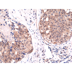Immunohistochemical staining of formalin fixed and paraffin embedded human breast cancer tissue sections using Anti-Akt1 RM252 at a 1:1000 dilution.