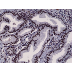 Immunohistochemical staining of formalin fixed and paraffin embedded human prostate cancer tissue section using anti-Androgen Receptor (N-term) rabbit monoclonal antibody (Clone RM254) at a 1:2500 dilution.