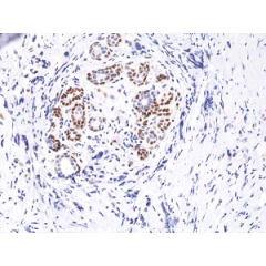 Immunohistochemical staining of formalin fixed and paraffin embedded human breast cancer tissue sections using Anti-Phospho-Stat3 (Tyr705) Rabbit Monoclonal Antibody (clone RM261) at a 1:10,000 dilution.