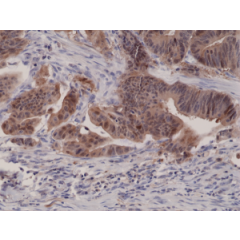 Immunohistochemical staining of formalin fixed and paraffin embedded human colon cancer tissue sections using Anti-p16INK4a RM267 at a 1:1000 dilution.