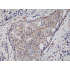 Immunohistochemical staining of formalin fixed and paraffin embedded human breast cancer tissue sections using Anti-CD44 Rabbit Monoclonal Antibody (Clone RM264) at a 1:5000 dilution.
