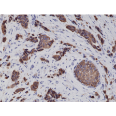 Immunohistochemical staining of formalin fixed and paraffin embedded human breast cancer tissue sections using Anti-CK8 Rabbit Monoclonal Antibody (Clone RM266) at a 1:2000 dilution.
