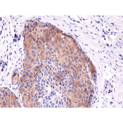 Immunohistochemical staining of formalin fixed and paraffin embedded human breast cancer tissue sections using Anti-Phospho-Acetyl CoA Carboxylase (Ser79) Rabbit Monoclonal Antibody (clone RM270) at a 1:5000 dilution.