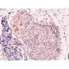Immunohistochemical staining of formalin fixed and paraffin embedded human breast cancer tissue sections using Anti-mTOR Rabbit Monoclonal Antibody (Clone RM274) at a 1:1000 dilution.