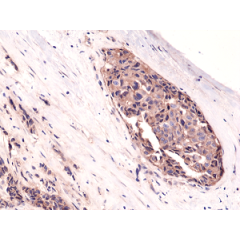 Immunohistochemical staining of formalin fixed and paraffin embedded human breast cancer tissue sections using Anti-β-Catenin Rabbit Monoclonal Antibody (Clone RM276) at a 1:1000 dilution.