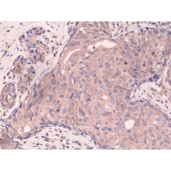 Immunohistochemical staining of formalin fixed and paraffin embedded human breast cancer tissue sections using Anti-Smad4 Rabbit Monoclonal Antibody (Clone RM277) at a 1:2000 dilution.