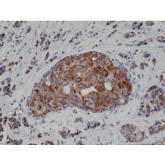 Immunohistochemical staining of formalin fixed and paraffin embedded human breast cancer tissue sections using Anti-CK18 Rabbit Monoclonal Antibody (Clone RM279) at a 1:4000 dilution.