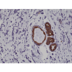 Immunohistochemical staining of formalin fixed and paraffin embedded human breast cancer tissue sections using Anti-CK7 Rabbit Monoclonal Antibody (Clone 284) at a 1:1000 dilution.