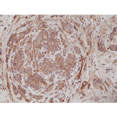 Immunohistochemical staining of formalin fixed and paraffin embedded human breast cancer tissue sections using anti-alpha-Actinin 4 rabbit monoclonal antibody (clone RM287) at a 1:200 dilution.