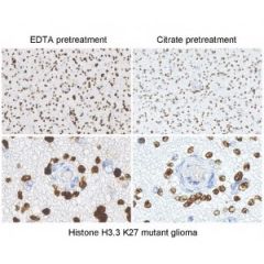 Immunostaining of brain tumor tissue sections using both EDTA and Citrate pretreatment methods. Clinically validated to be Positive for the H3.3 K27M Mutation by Sanger sequencing. Image courtesy of Sebastian Brandner MD, Division of Neuropathology and De