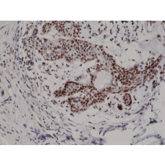 Immunohistochemical staining of formalin fixed and paraffin embedded human breast cancer tissue section using anti-p27Kip1 rabbit monoclonal antibody (clone RM302) at a 1:200 dilution.
