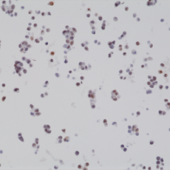 Immunohistochemical staining of formalin fixed and paraffin embedded 22RV1 cell section using anti-BAG-1L rabbit monoclonal antibody (Clone RM310) at a 1:2000 dilution.