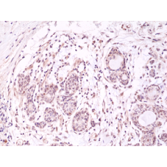 Immunohistochemical staining of formalin fixed and paraffin embedded human breast cancer tissue section using anti-AKT (PH domain) rabbit monoclonal antibody (Clone RM316) at a 1:500 dilution.
