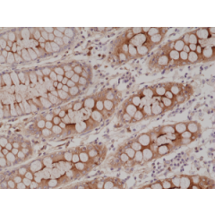 Immunohistochemical staining of formalin fixed and paraffin embedded human colon tissue section using anti-CEA rabbit monoclonal antibody (Clone RM326) at a 1:2000 dilution.